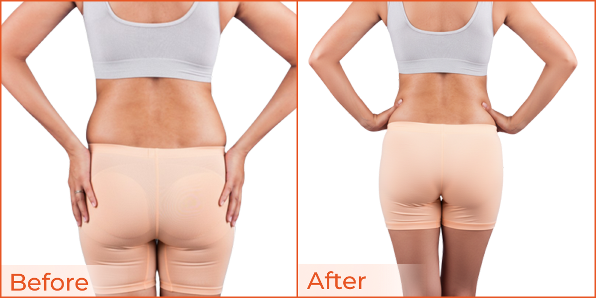 Love handles (Flanks)