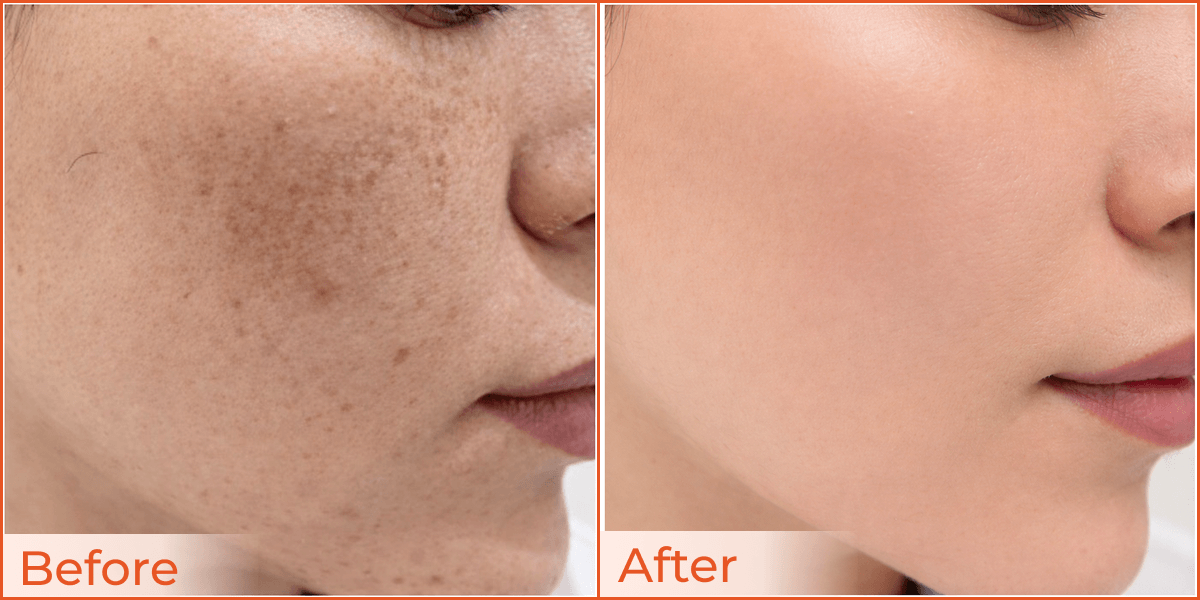 Improvement In Pigmentation 