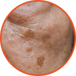 Age Spots