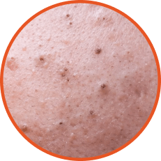 Blackheads