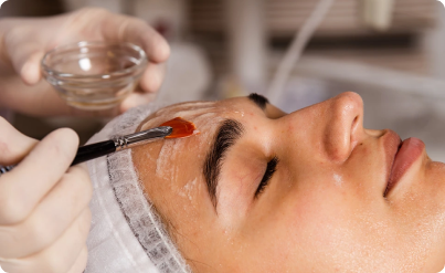 Chemical Peel