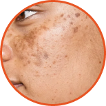 Complexion