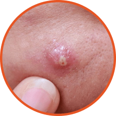 Cystic Acne