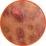 Inflammatory