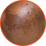 Melasma