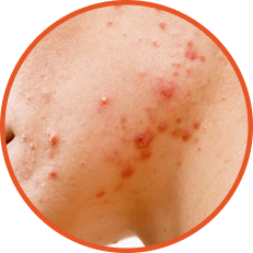 Nodular Acne