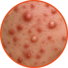 Papules