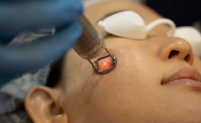 Pico Laser