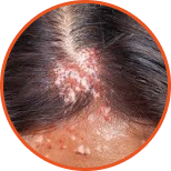 Psoriasis