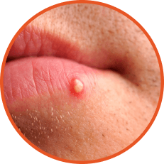 Pustules