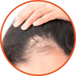 Stress-Haire-loss
