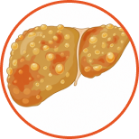 fatty-liver-1