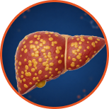 fatty-liver-3